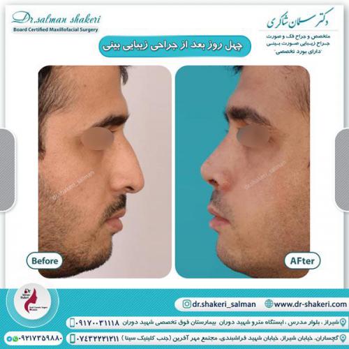 جراحی بینی 40