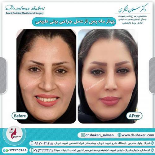 جراحی بینی 42