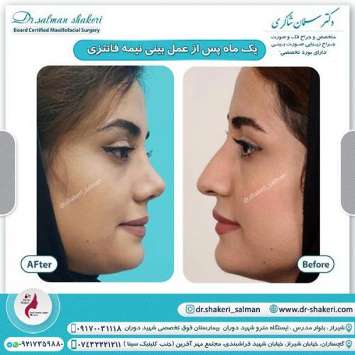 جراحی بینی 44