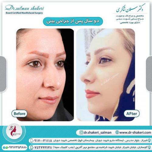 جراحی بینی 47