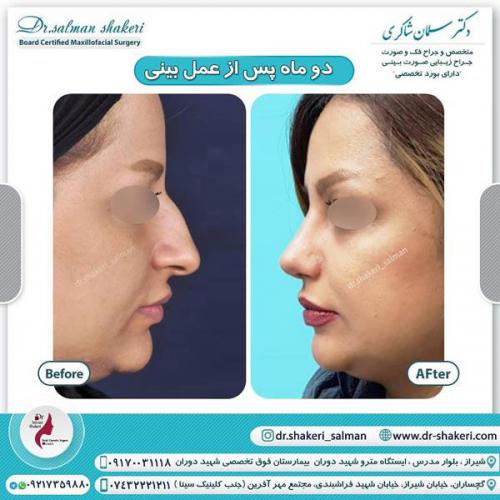 جراحی بینی 49