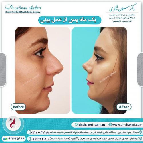 جراحی بینی 50