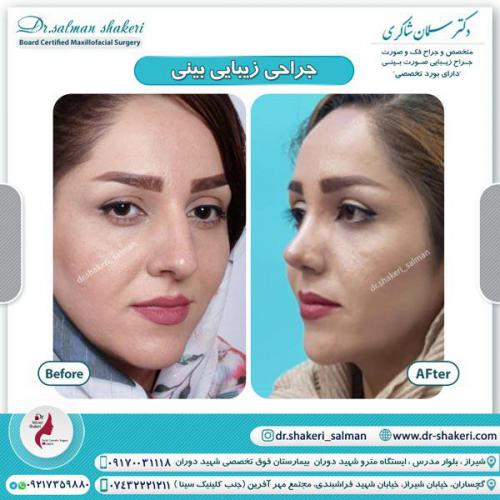 جراحی بینی 52