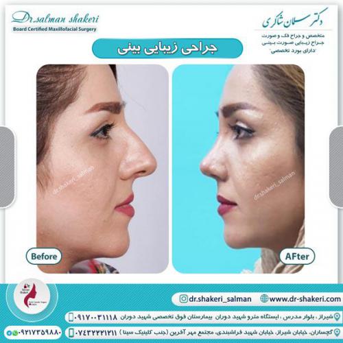 جراحی بینی 53