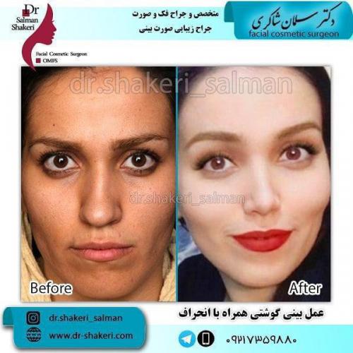 جراحی بینی 56 (1)