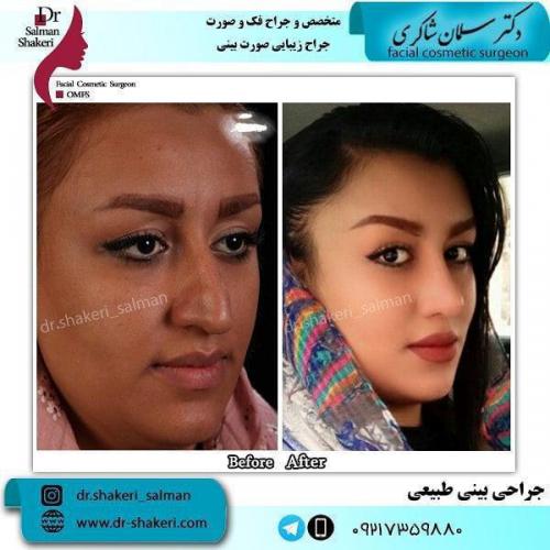 جراحی بینی 57