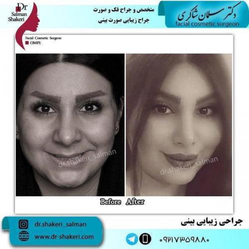 جراحی بینی 58