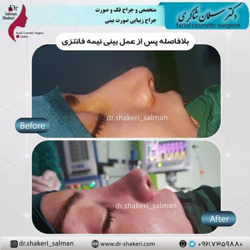 جراحی بینی 60