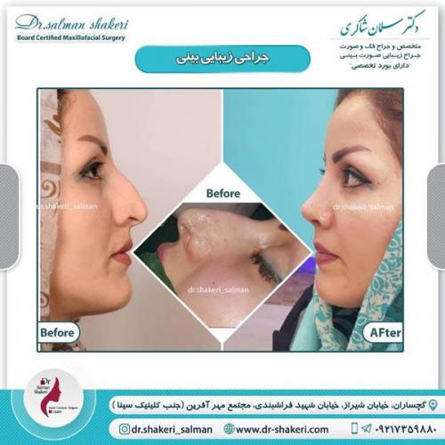 جراحی بینی 62