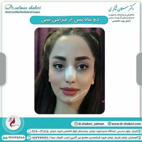 جراحی بینی 64