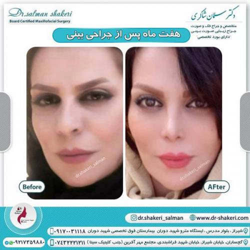 جراحی بینی 65