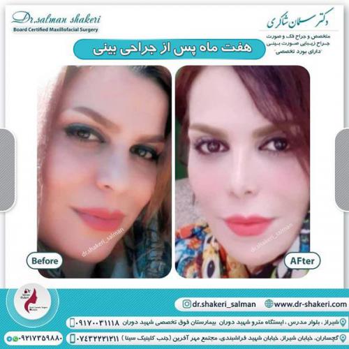 جراحی بینی 66