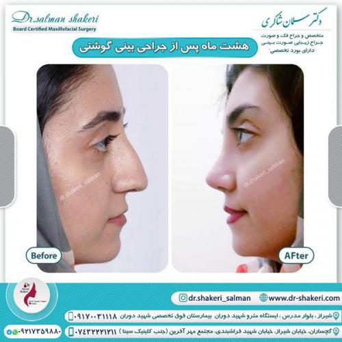 جراحی بینی 67