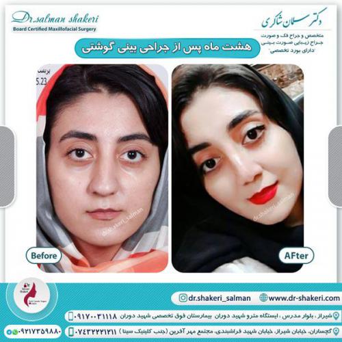 جراحی بینی 68