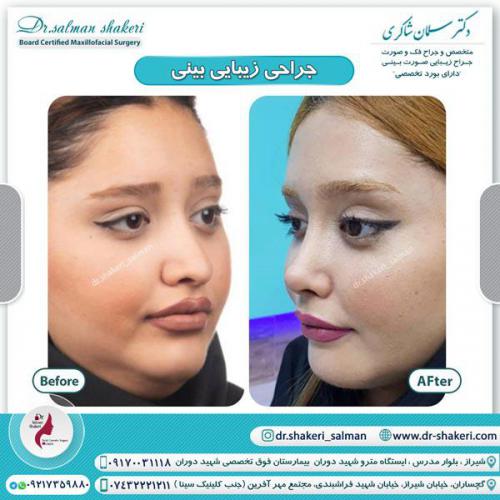 جراحی بینی 73