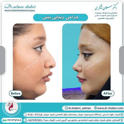 جراحی بینی 74