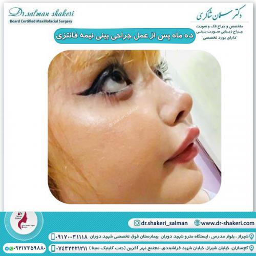 جراحی بینی 75