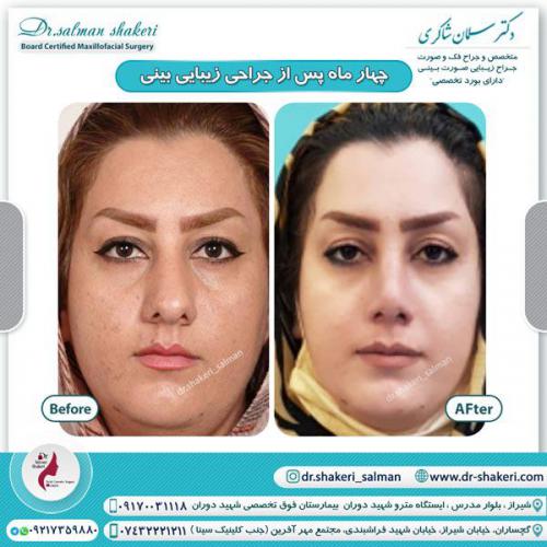 جراحی بینی 76