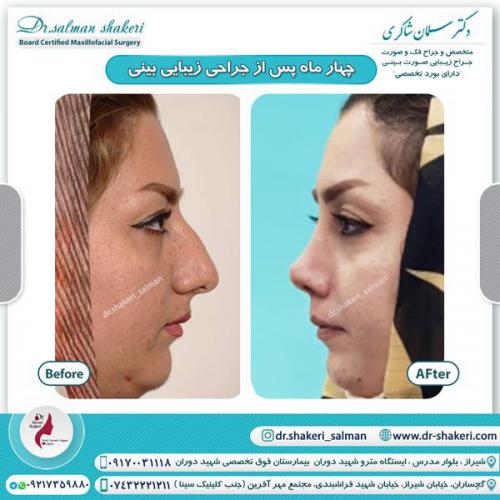 جراحی بینی 77