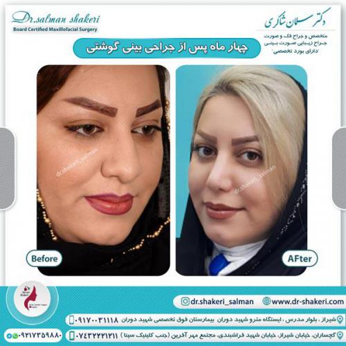 جراحی بینی 78