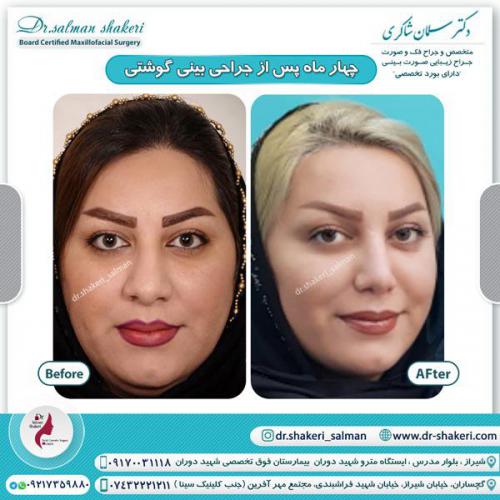 جراحی بینی 79