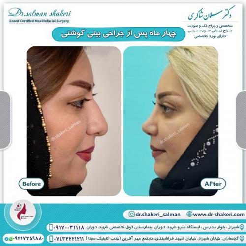 جراحی بینی 80