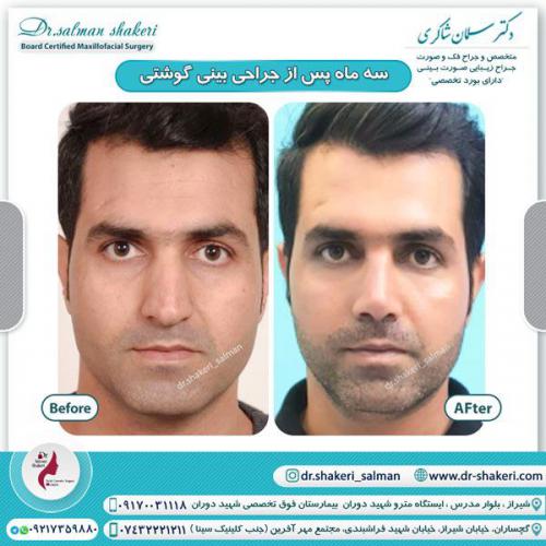 جراحی بینی 81