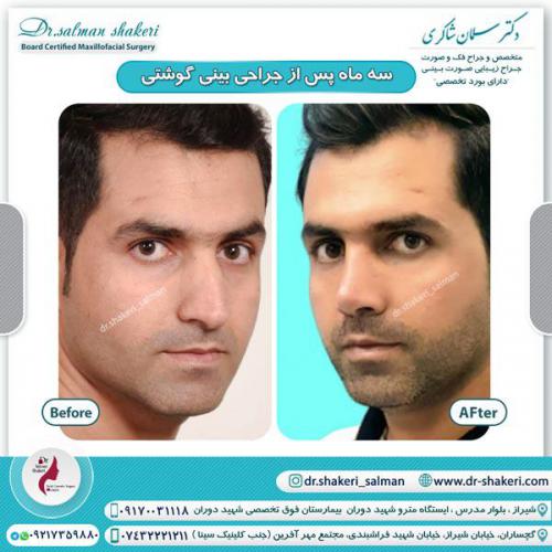 جراحی بینی 82