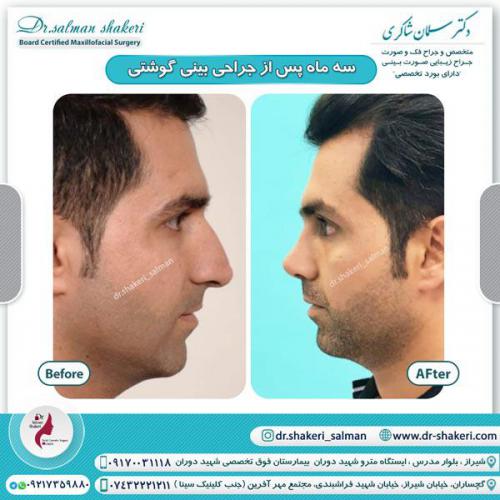 جراحی بینی 83