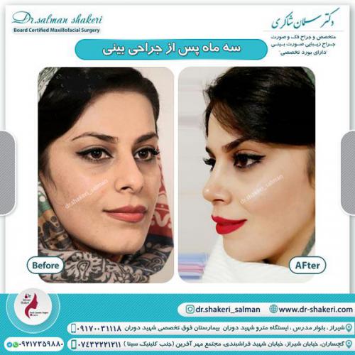 جراحی بینی 84