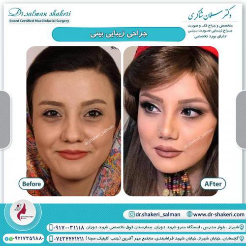 جراحی بینی 85