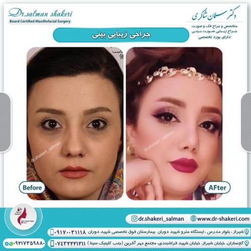 جراحی بینی 86