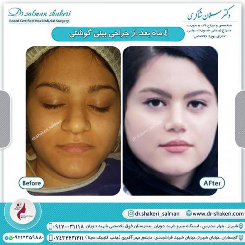 جراحی بینی 87