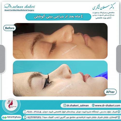 جراحی بینی 88