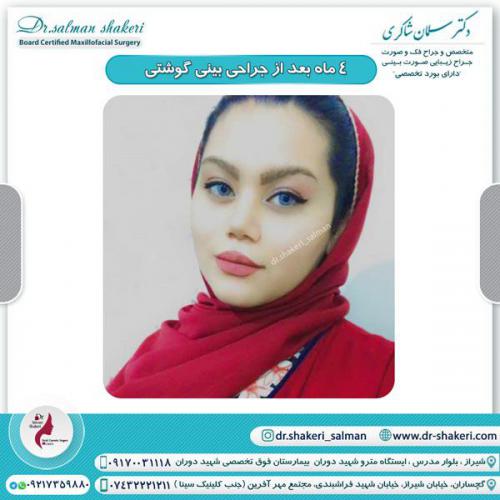 جراحی بینی 89