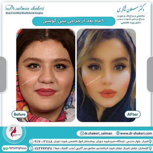 جراحی بینی 90