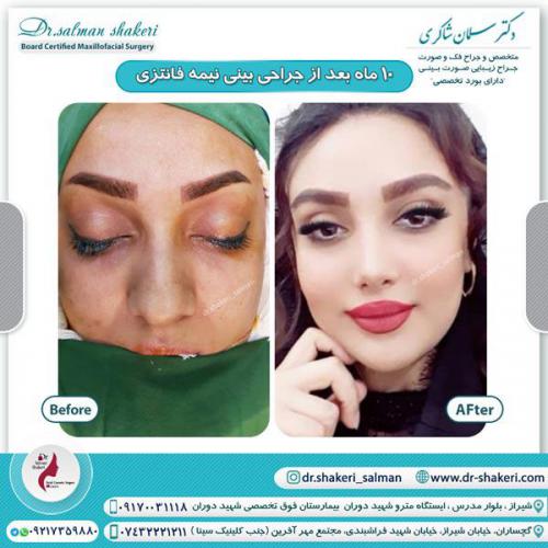 جراحی بینی 93