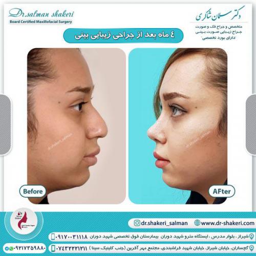 جراحی بینی 96