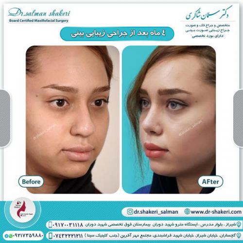 جراحی بینی 97