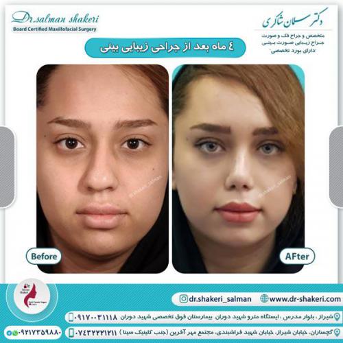 جراحی بینی 98