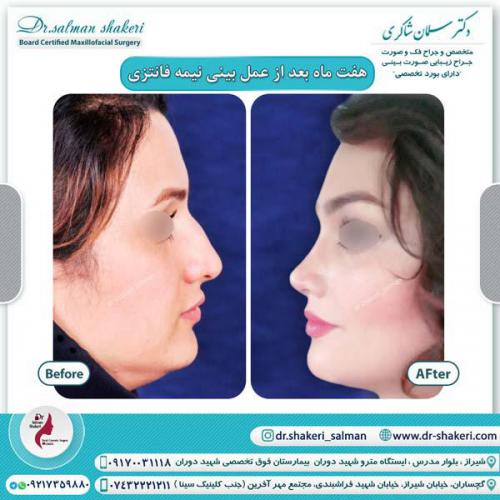 جراحی بینی 99